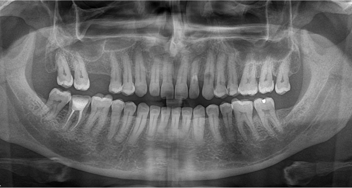 Deep caries with visible periapical involvement before root canal.
