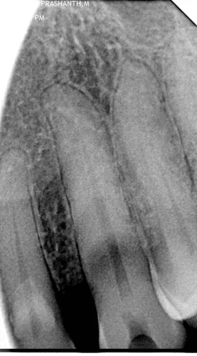 Before Image: Shows deep caries and periapical changes on tooth #29.