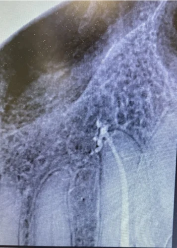 After Image: Displays completed root canal and zirconia crown placement.