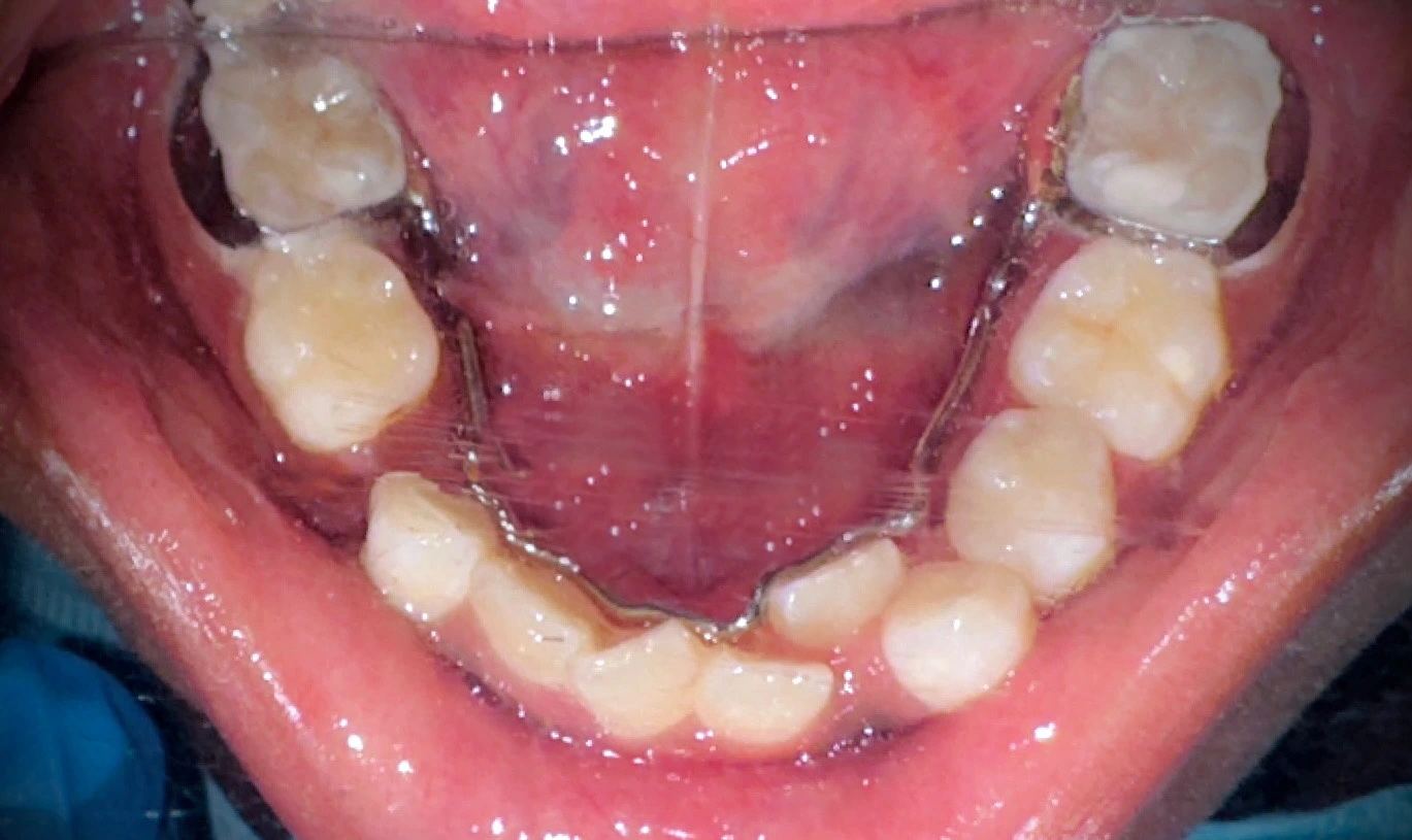 Loss of primary molar of the lower jaw in advance of the inserted space maintainer