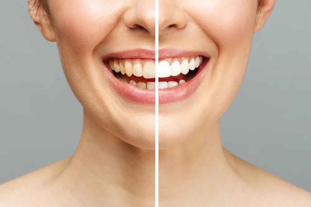 Benefits of Teeth Bleaching