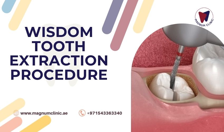 Breakdown of Wisdom Tooth Extraction Procedure