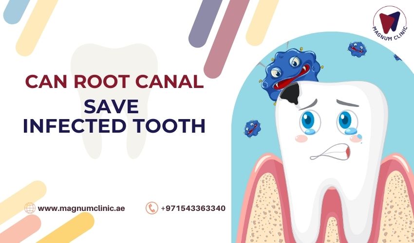 Can Root Canal Treatment Save Infected Tooth
