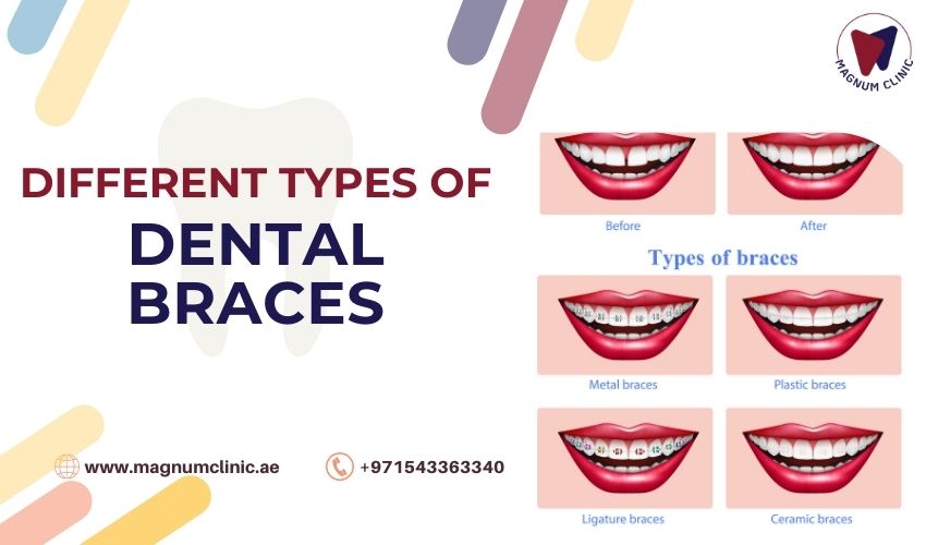 Different Types of Dental Braces - Magnum Clinic