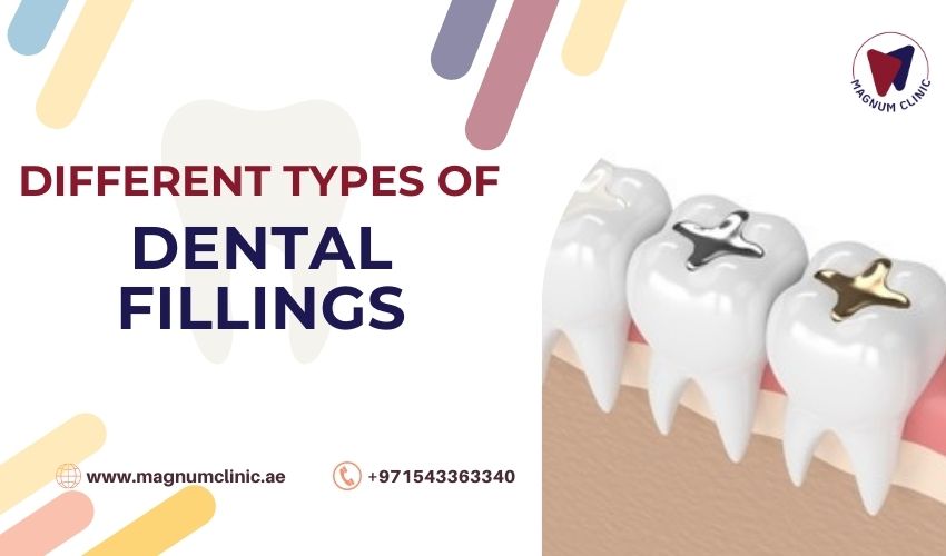 Different Types of Dental Fillings
