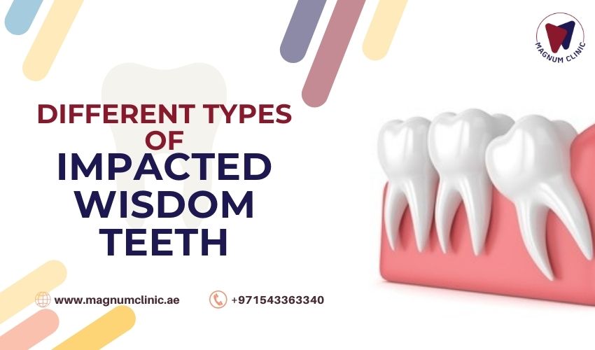 Different Types of Impacted Wisdom Teeth
