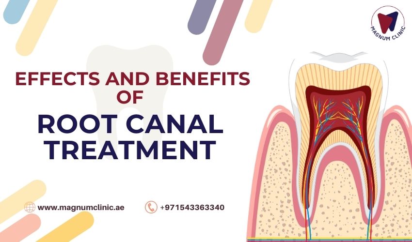 Effects and Benefits of Root Canal Treatment