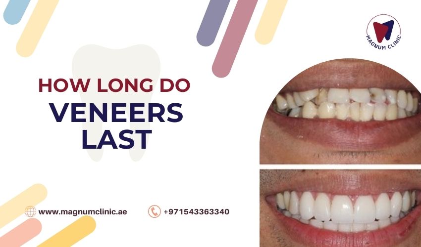 How Long Do Veneers Last - Magnum Clinic