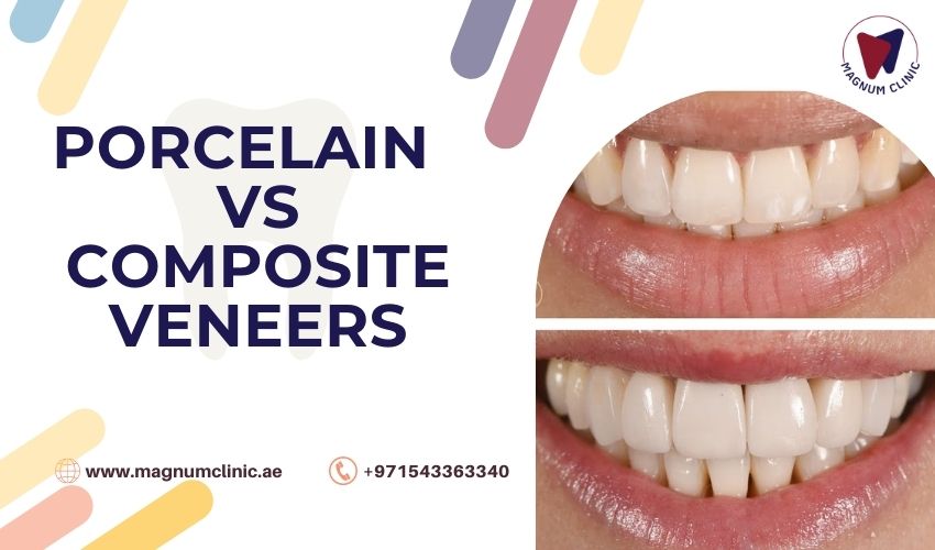 Porcelain Veneers vs Composite Veneers Which One Right For You