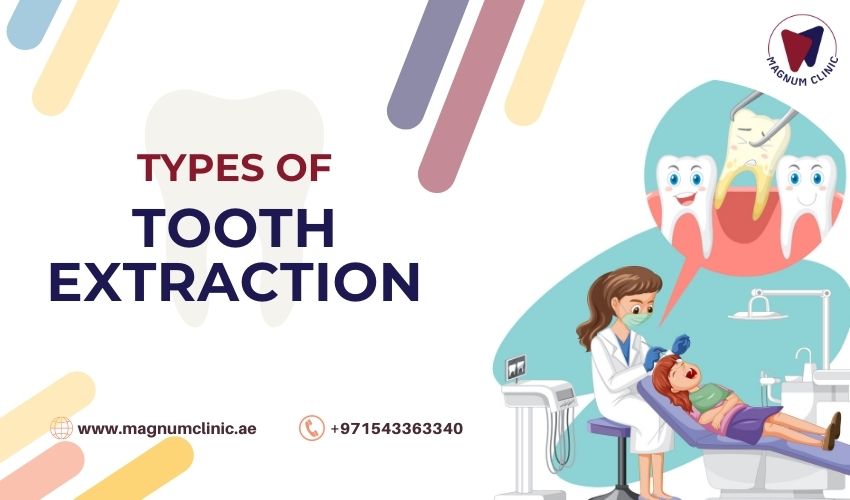 Types of Tooth Extraction - Magnum CLinic