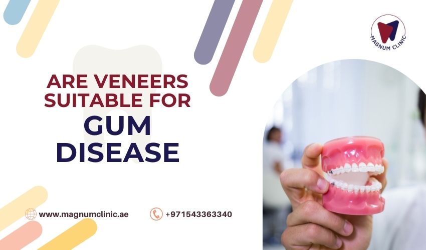 Veneers Suitable for Gum Disease - Magnum Clinic