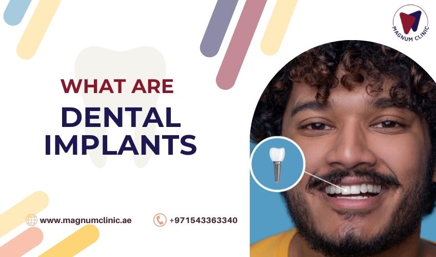What Are Dental Implants - Magnum Clinic