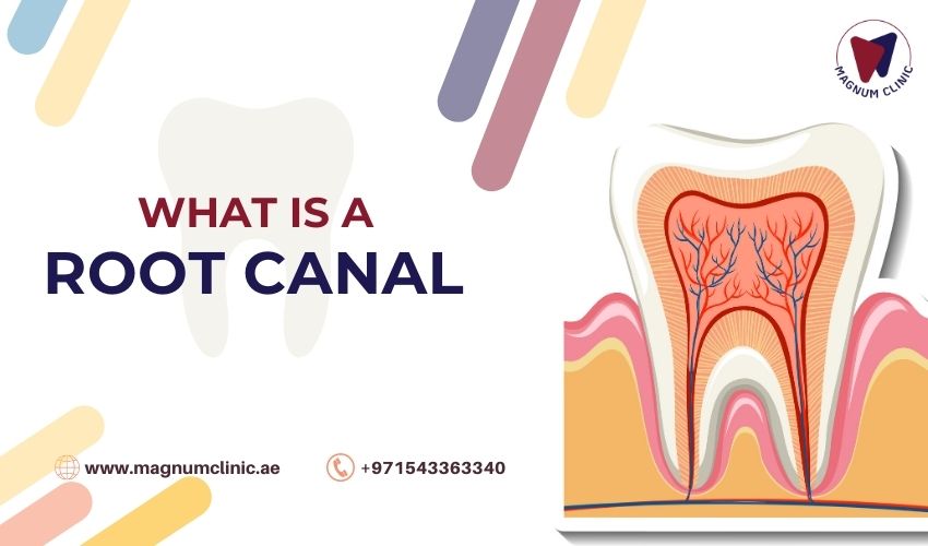 What Is a Root Canal - Magnum Clinic