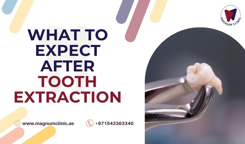 What to Expect After Tooth Extraction